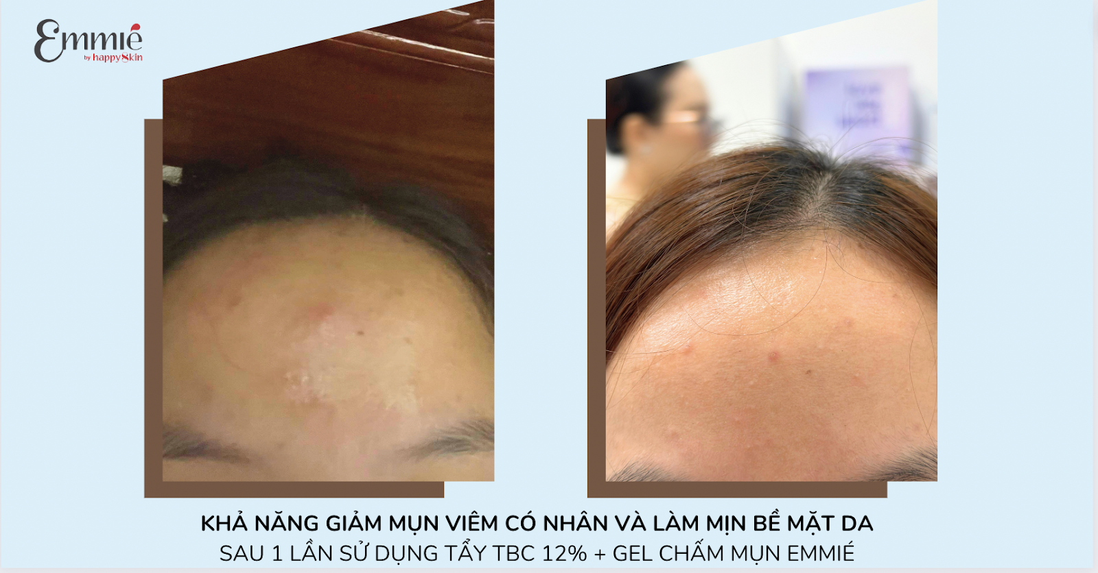 Hiệu quả giảm mụn của Dung Dịch Tẩy Tế Bào Chết All Target Skin Renewing Solution Pionin + 12% AHA/BHA/PHA