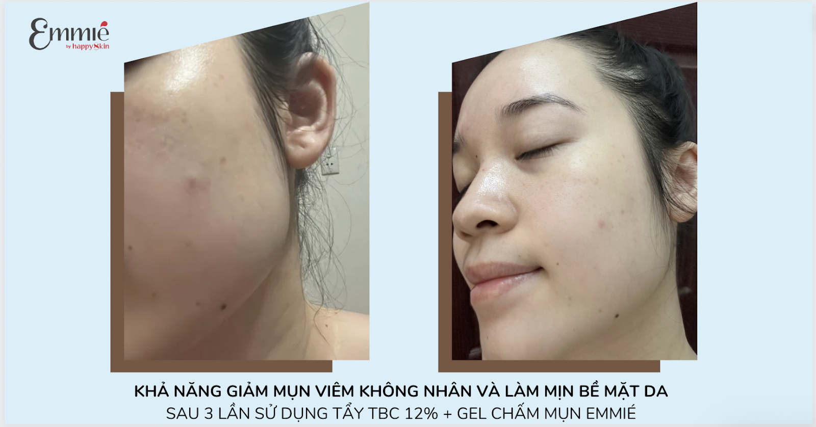 Hiệu quả giảm mụn của Dung Dịch Tẩy Tế Bào Chết All Target Skin Renewing Solution Pionin + 12% AHA/BHA/PHA